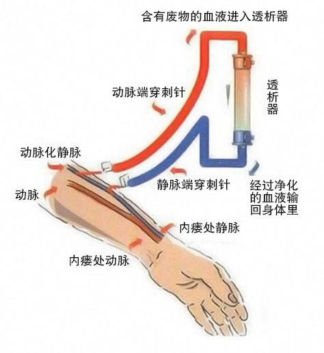 透析血管娄是什么原理_肝透析是什么情况