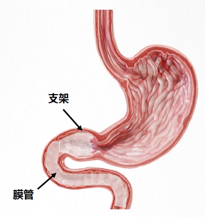 胃转流支架示意图2.png